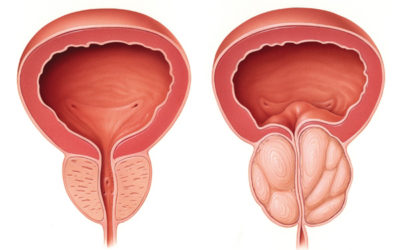 La importancia de detectar cuanto antes la hiperplasia benigna de próstata