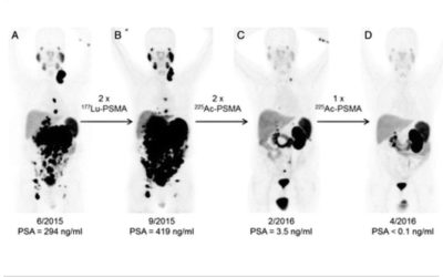 Teragnosis: el nuevo tratamiento contra el cáncer de próstata