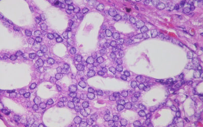 Biopsia líquida SelectMDx. Caso clínico 2
