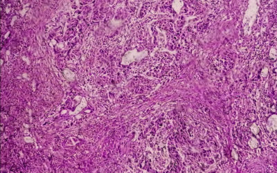 Cáncer de vejiga: la epidemia silenciosa que ya suma 600.000 diagnósticos anuales en el mundo y roza los 24.000 casos en España