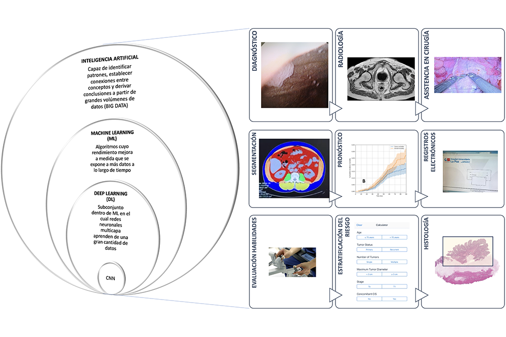 Avance de la inteligencia artificial en urologia